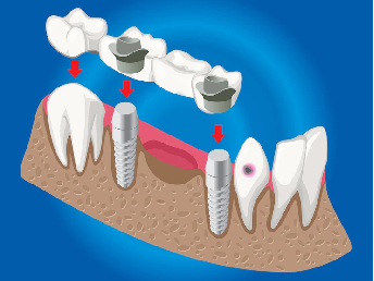 Fixed Teeth And Bridges
