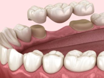 Bridges & Dental Crown